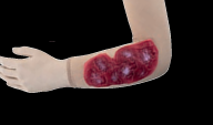 Body-Arm Sleeve-Wound